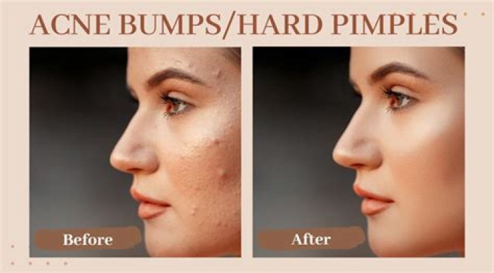 What to mix with honey to clear pimples?