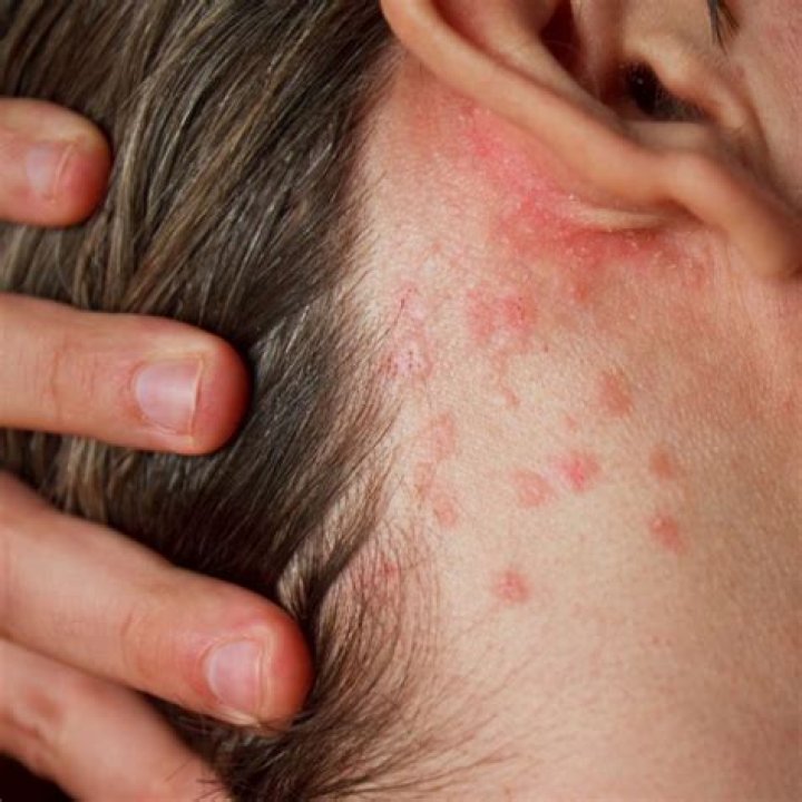 What triggers an outbreak of shingles?