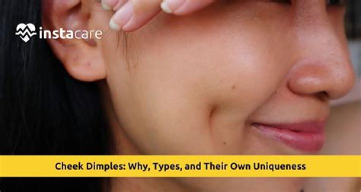 What type of dimples are rare?