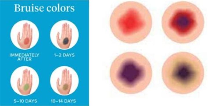 When does a bruise turn into a lump?