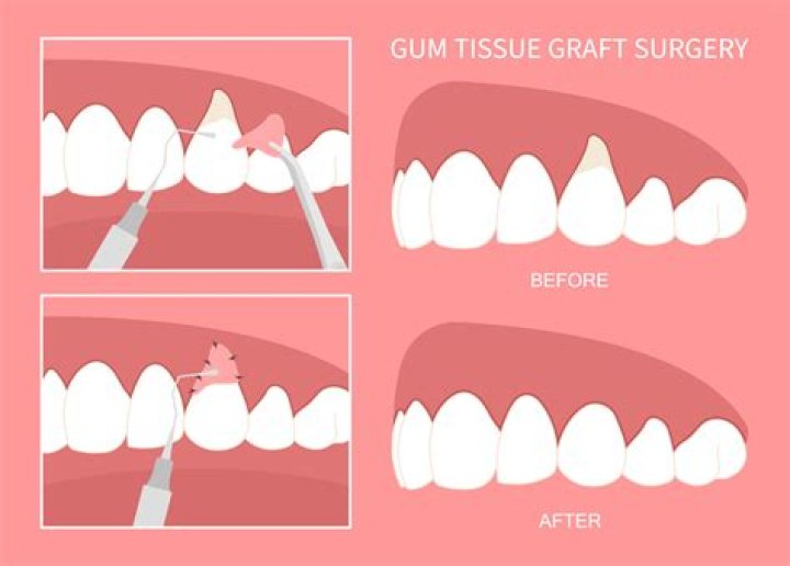 When does a gum graft fail?
