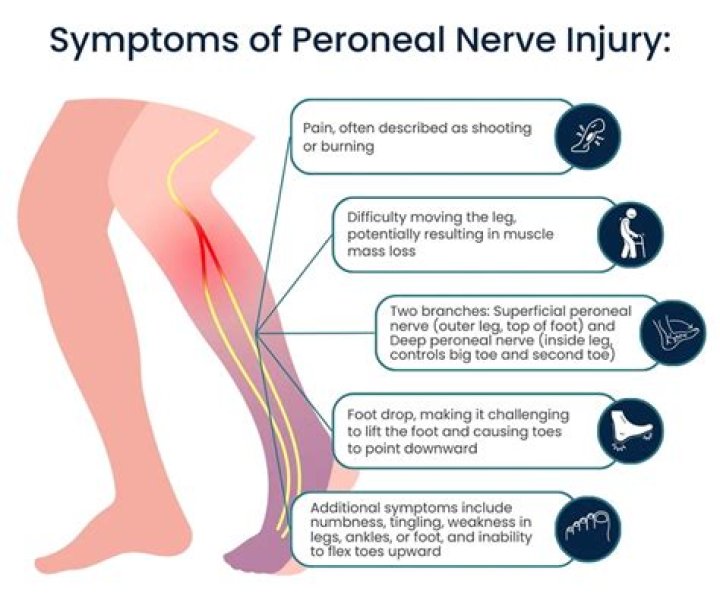 When does a pinched nerve need surgery?