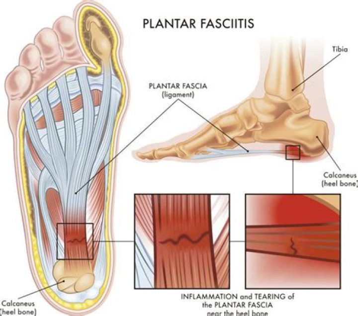 When does plantar fasciitis hurt the most?