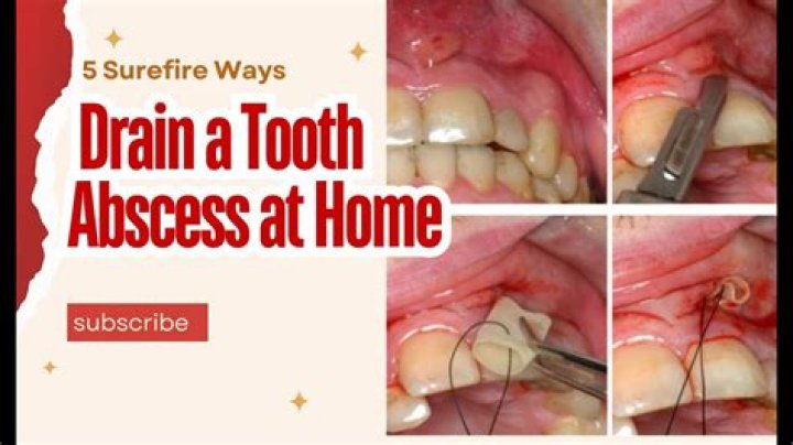 When should I go to the hospital for an abscessed tooth?