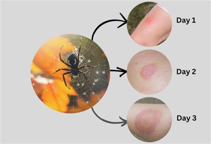 When should you go to the ER for a spider bite?