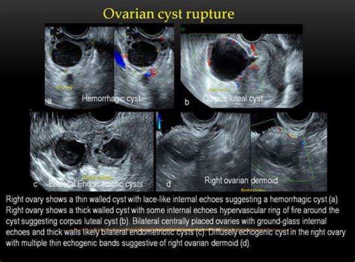 When should you go to the ER for an ovarian cyst?