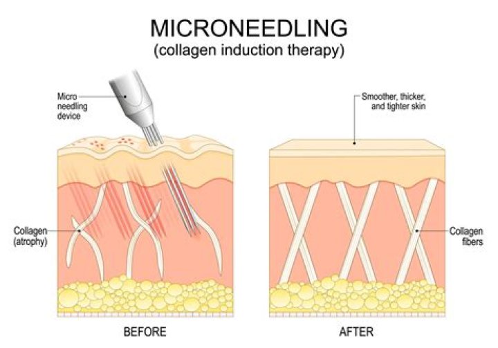When should you not do microneedling?