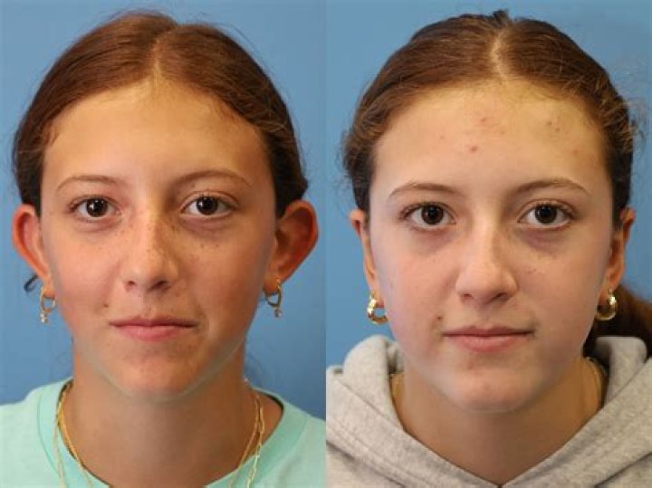When will my ears look normal after otoplasty?