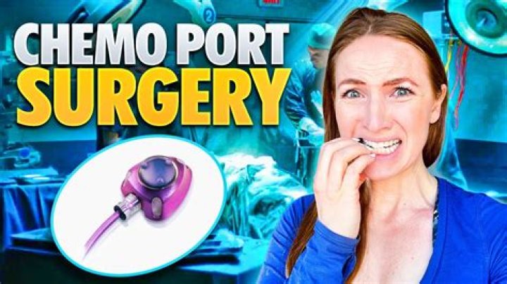 Where do they place a port for chemo?