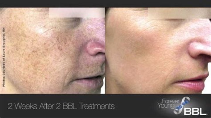 Which laser is best for dark spots?