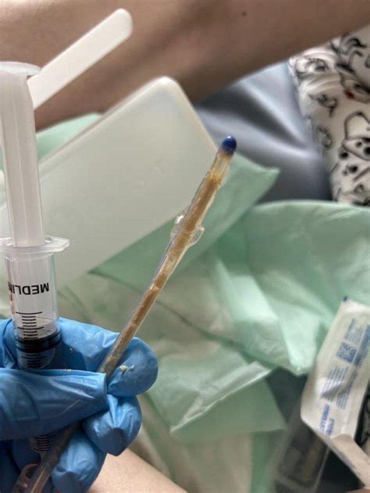 Why am I peeing around my catheter?