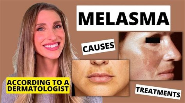 Why am I suddenly getting melasma?