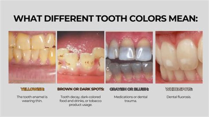 Why are kids teeth grey?