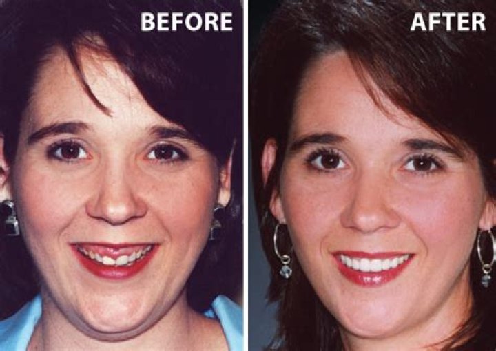 Why are some people's gums so big?