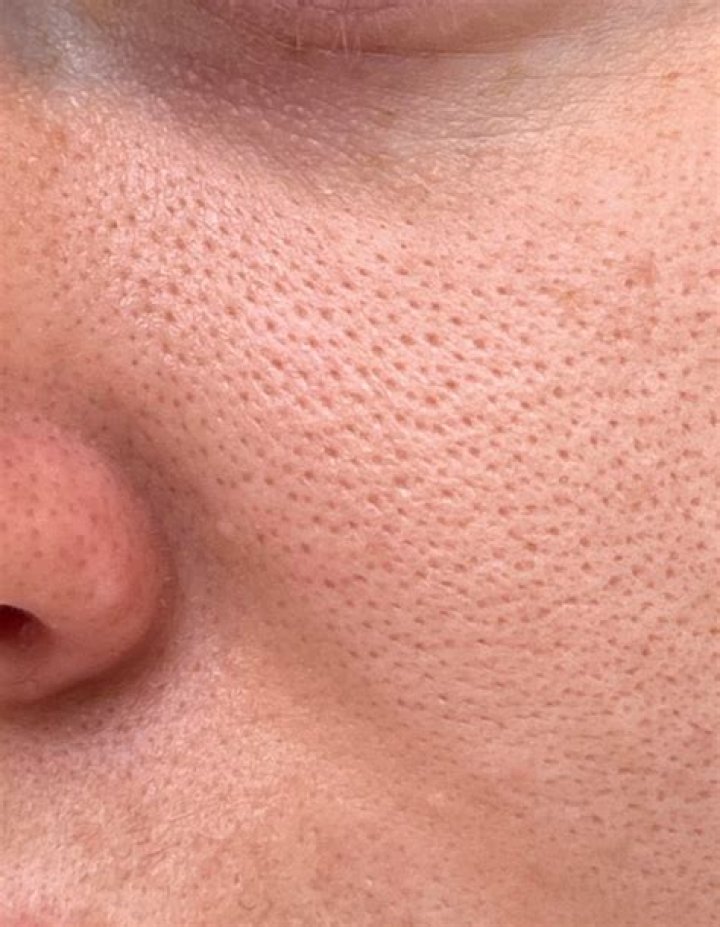 Why are the pores on my nose so big?