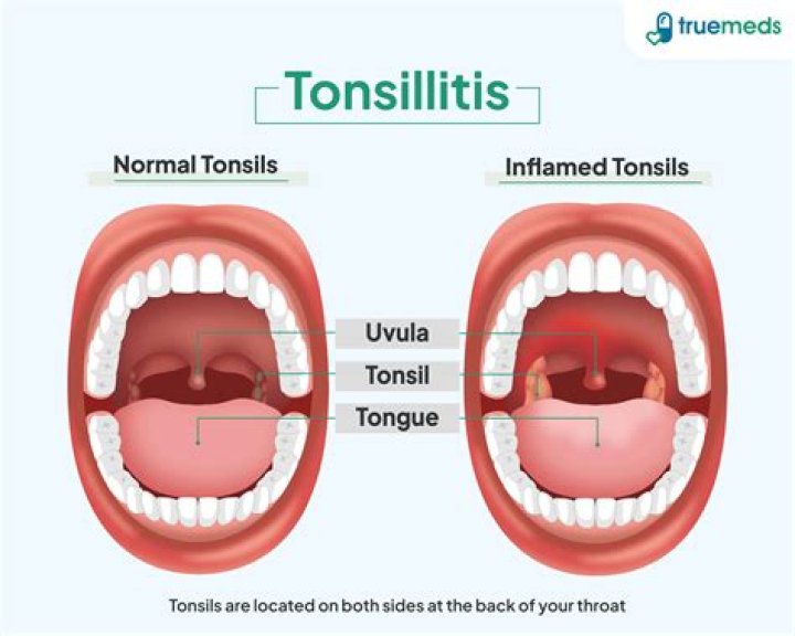 Why did my uvula get longer?