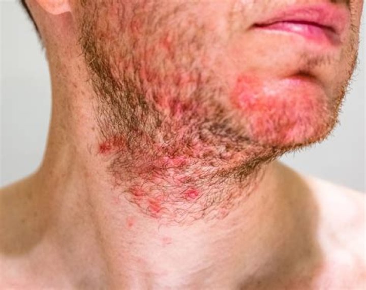 Why do beards itch when growing?