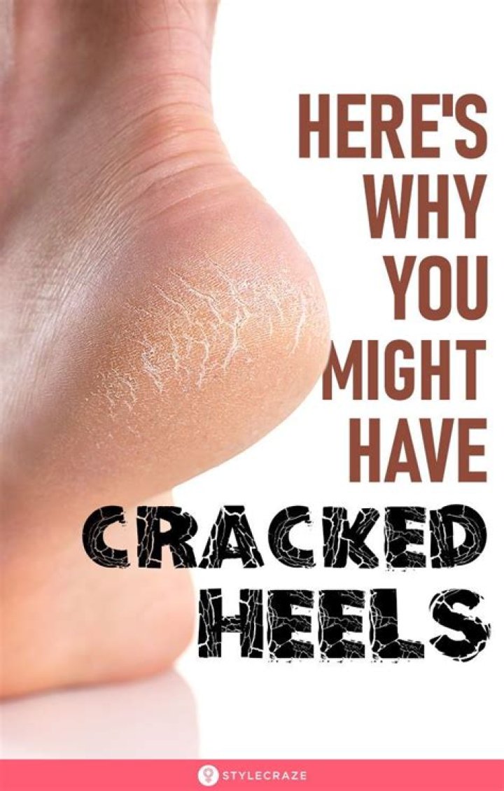 Why do heels crack?