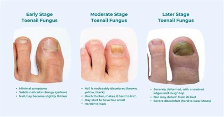Why do I have a second toenail?