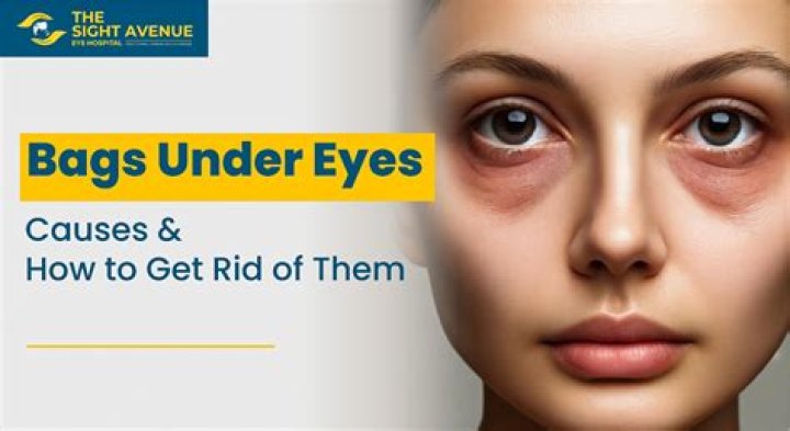 Why do I have bags under my eyes at 13?