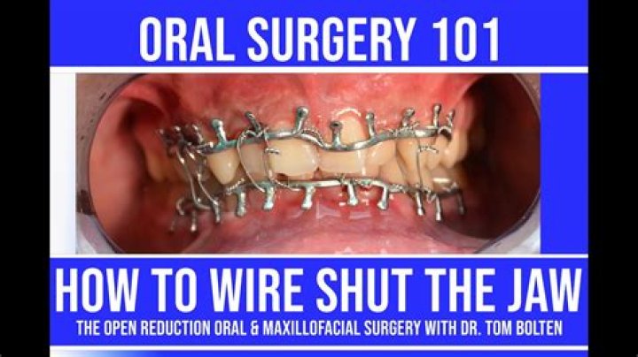 Why do morticians sew mouths shut?