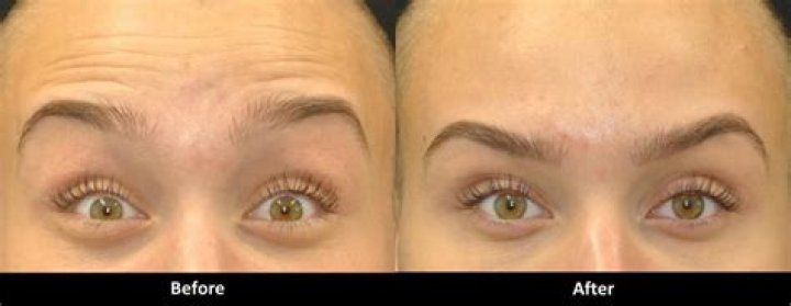 Why do my eyebrows feel heavy after Botox?