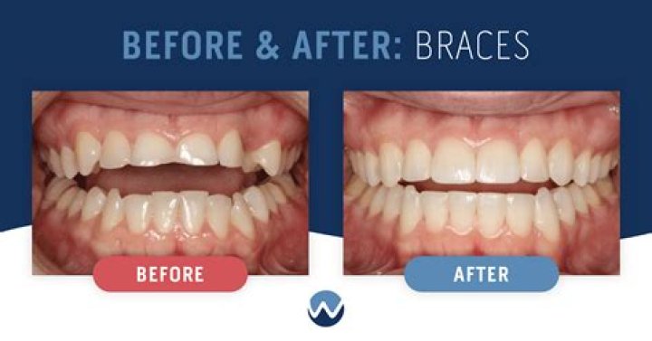 Why do my teeth look weird after I get my braces off?