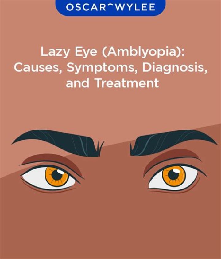 Why do so many actors have lazy eyes?