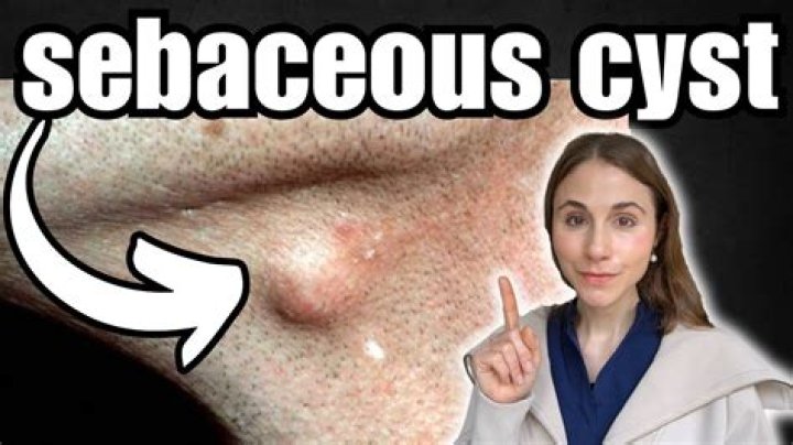 Why do you get cysts?