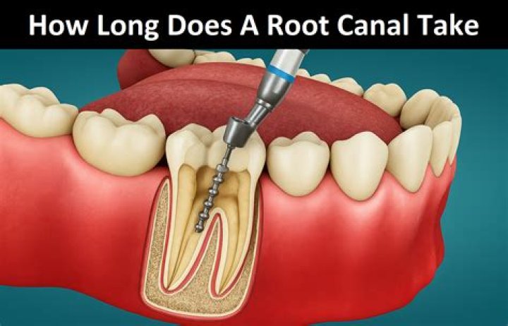 Why does a root canal take 3 visits?