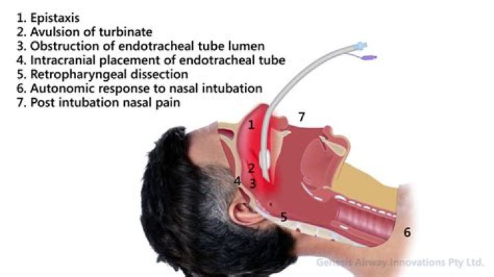 Why does intubation hurt?