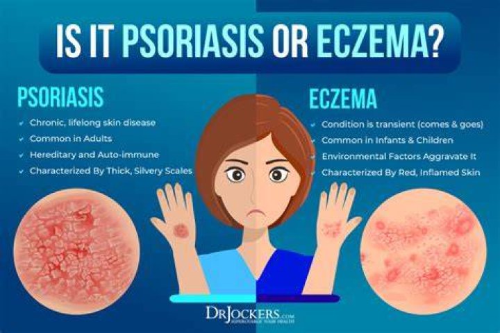 Why does my eczema burn?