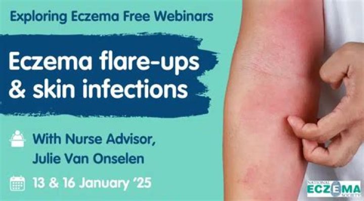 Why does my eczema flare-up after a shower?