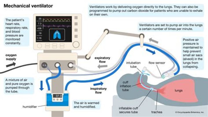 Why is a person put on ventilator after stroke?