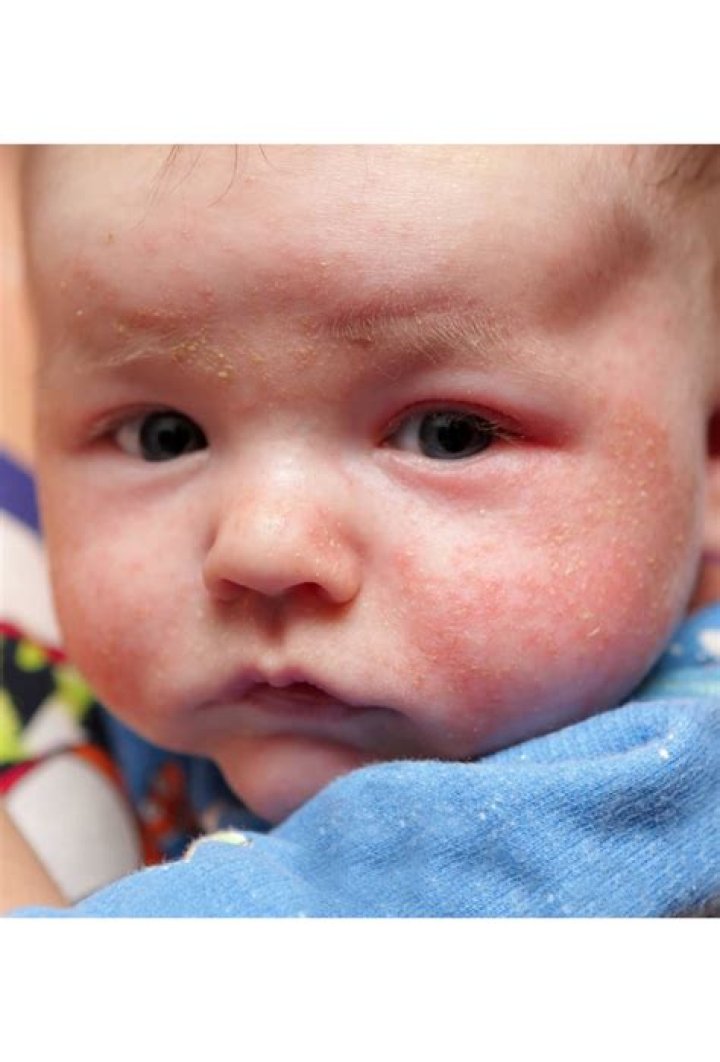 Why is eczema so common?