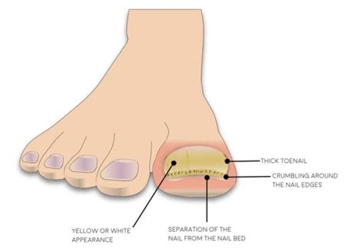 Why is my big toenail white?