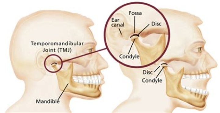 Why is my TMJ getting worse?