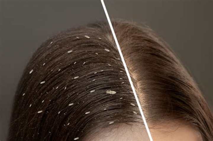 Why won't the lice go away?
