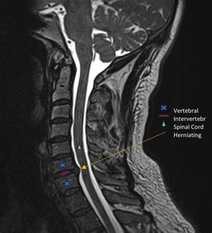 Will an MRI show a pinched nerve?