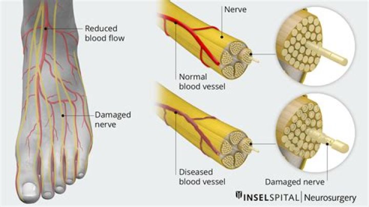 Will lowering blood sugar help neuropathy?
